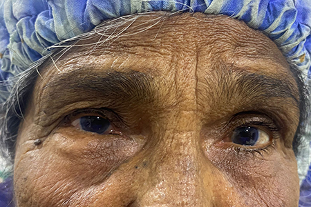 pre surgery